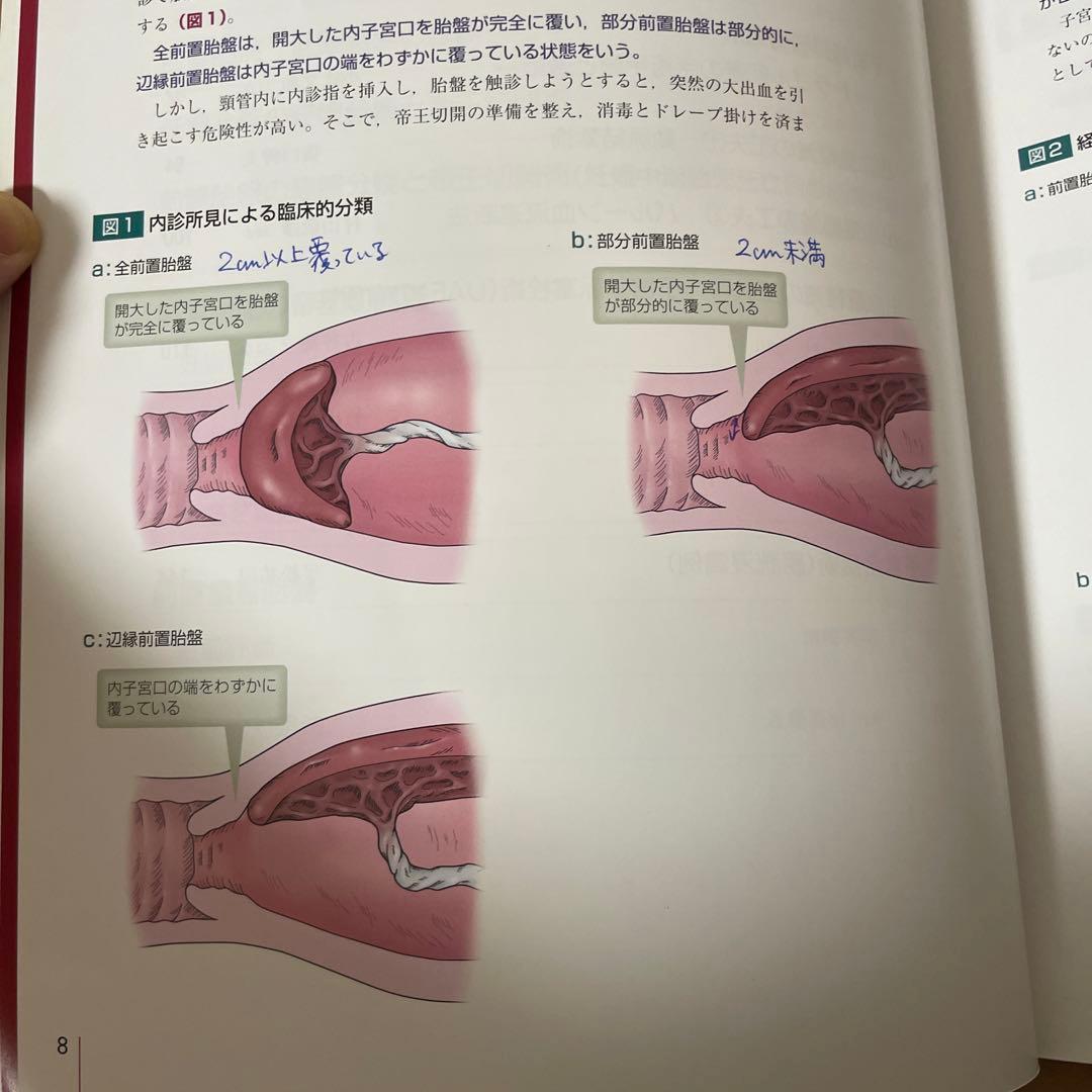 前置胎盤・前置癒着胎盤の手術 : 入念な準備で危機に対処