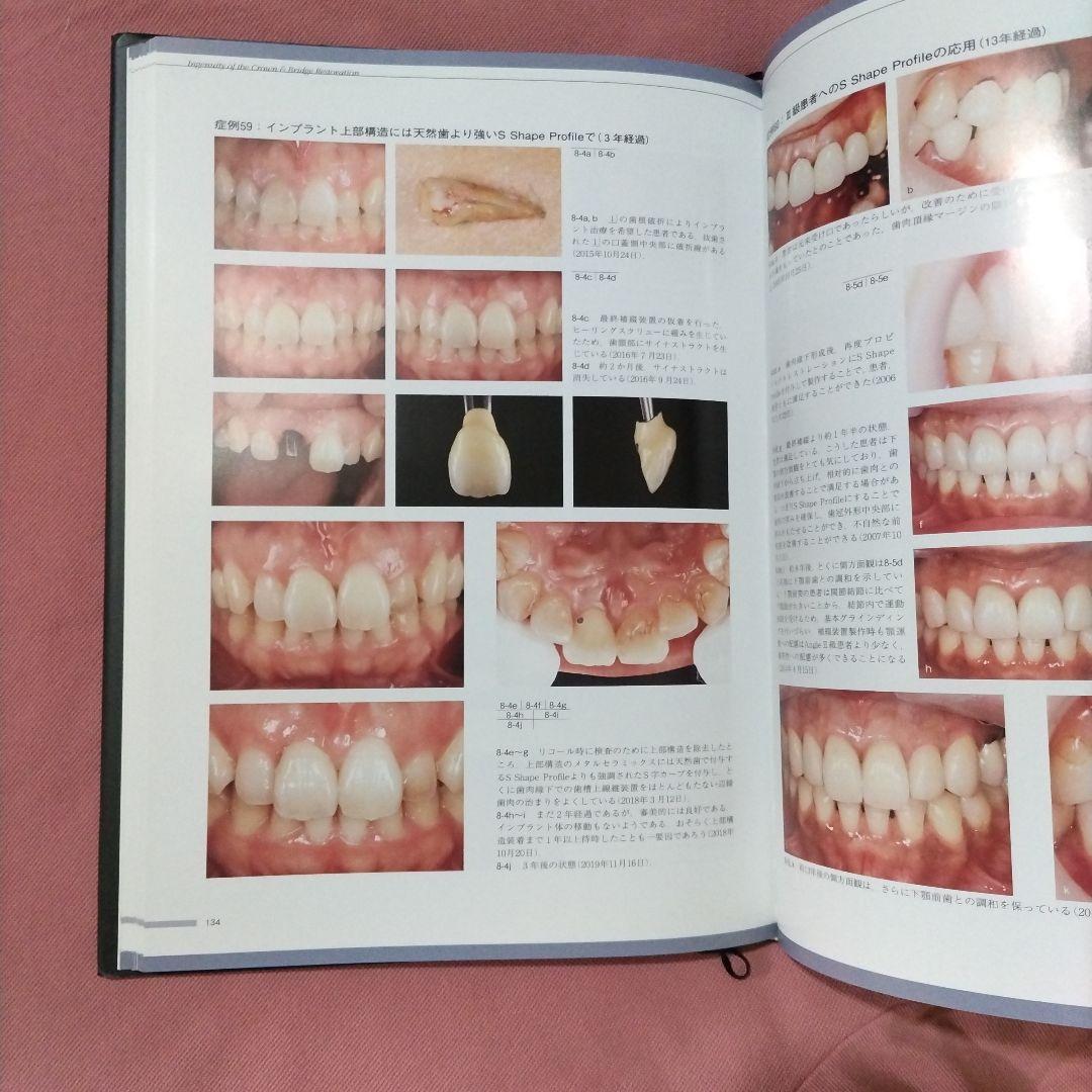 攻めのクラウン・ブリッジ = Ingenuity of the Crown &…